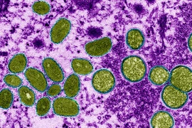 Tailandia detecta un nuevo caso de viruela del simio