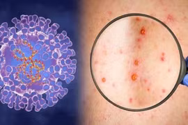 Ciudad Ho Chi Minh registra otro caso de viruela del mono