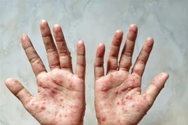 Camboya registra 12 casos de viruela simica
