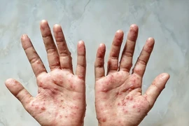 Camboya registra 12 casos de viruela símica