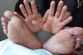 Vietnam advierte sobre riesgo de propagación de fiebre aftosa humana 