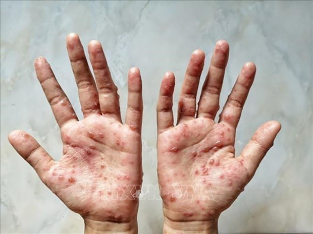 Laos detecta el primer caso de viruela símica ảnh 1 Laos detecta el primer caso de viruela símica ảnh 1