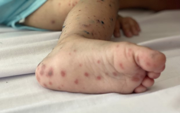 Primera vacuna contra la fiebre aftosa en espera de aprobación ảnh 1 Primera vacuna contra la fiebre aftosa en espera de aprobación ảnh 1