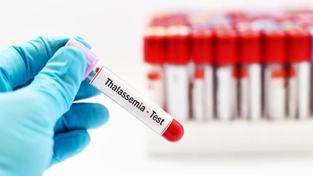Indonesia entre países con alta tasa de hemólisis congénita ảnh 1 Indonesia entre países con alta tasa de hemólisis congénita ảnh 1