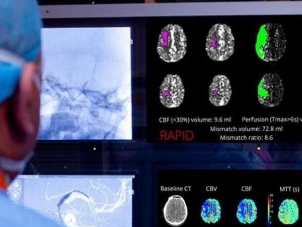 Aplican la inteligencia artificial en el diagnóstico y tratamiento del ataque cerebral ảnh 1