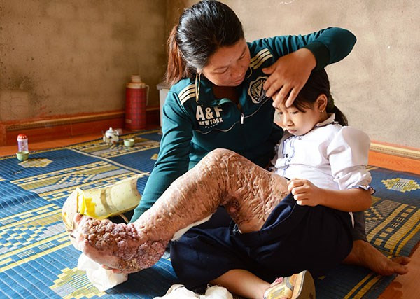 Instituto de investigación de EE.UU. elogia a Vietnam por erradicar la elefantiasis ảnh 1 Instituto de investigación de EE.UU. elogia a Vietnam por erradicar la elefantiasis ảnh 1