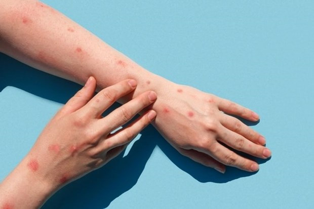 Indonesia trabaja para abordar riesgo de un brote de viruela símica ảnh 1 Indonesia trabaja para abordar riesgo de un brote de viruela símica ảnh 1