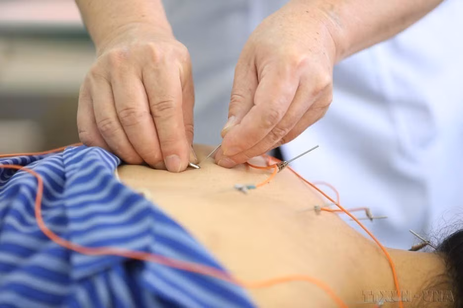 Utilizando el método de electroacupuntura para tratar a pacientes en el Hospital de Medicina Tradicional de Lang Son. (Foto: VNA)
