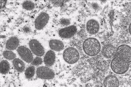 Vietnam detecta primer caso de viruela símica