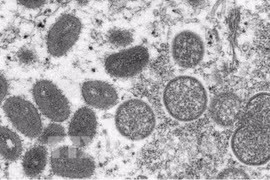 Vietnam aún sin registrar casos de viruela símica