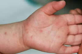 Garantizan medicamentos para tratamiento de enfermedad de manos, pies y boca