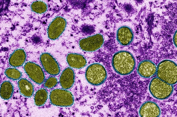 Tailandia detecta un nuevo caso de viruela del simio ảnh 1