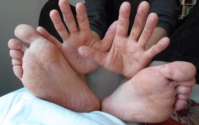 Vietnam advierte sobre riesgo de propagación de fiebre aftosa humana ảnh 1