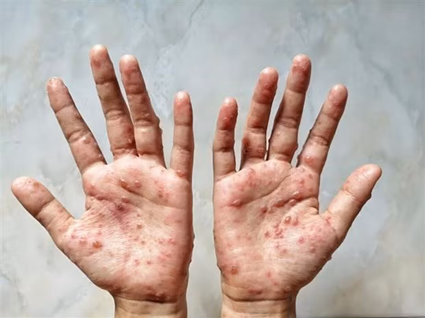 Camboya registra 12 casos de viruela simica ảnh 1