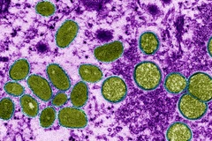 Tailandia detecta un nuevo caso de viruela del simio