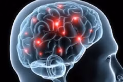 Demencia cerebro-vascular, enfermedad más frecuente en Asia
