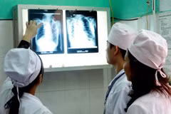Vietnam con el mayor número de pacientes con aspergilosis en el mundo