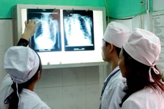 Vietnam con el mayor número de pacientes con aspergilosis en el mundo