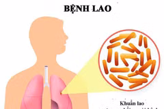 Premier de Vietnam llama a fortalecer lucha contra tuberculosis