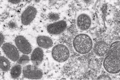 Vietnam aún sin registrar casos de viruela símica