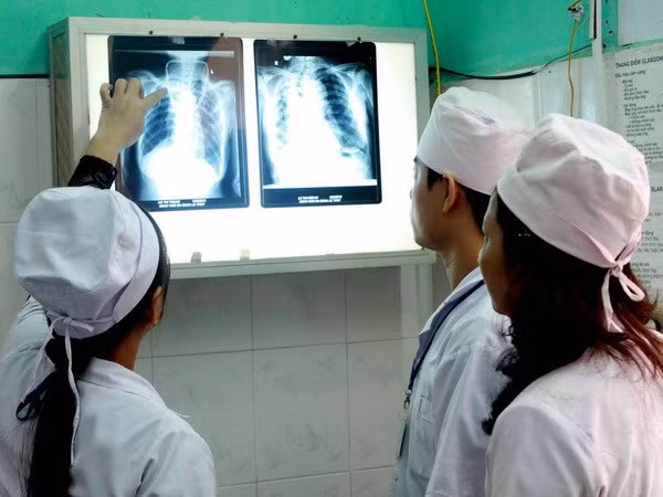 Vietnam con el mayor número de pacientes con aspergilosis en el mundo ảnh 1
