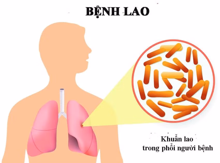Premier de Vietnam llama a fortalecer lucha contra tuberculosis ảnh 1