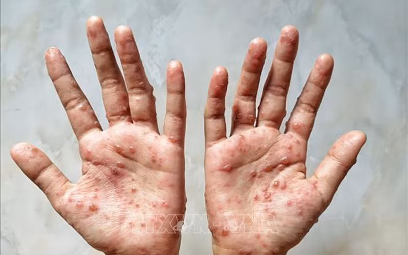 Ministerio de Salud recomienda medidas para prevenir la viruela símica ảnh 1